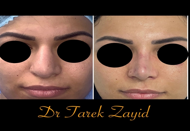 علامات جمال الأنف